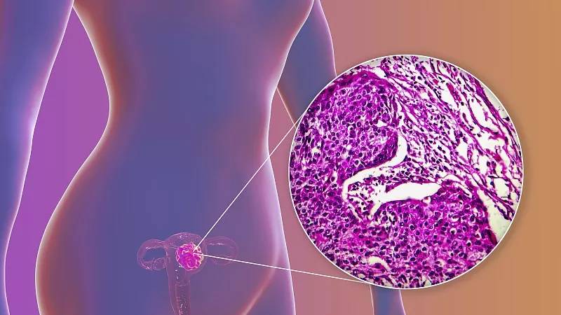 NK细胞免疫疗法联合化疗，可提高晚期卵巢癌患者五年生存率 (图1)
