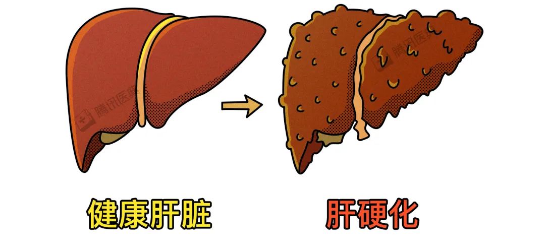 王福生院士：脐带间充质干细胞显著改善失代偿性肝硬化的肝功能，提高长期生存率(图2)