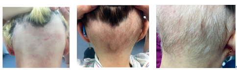4例斑秃患者经间充质干细胞治疗后，均生长了头发(图5)