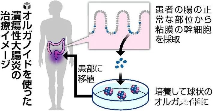 好消息！全球首例！日本团队利用自体细胞进行溃疡性结肠炎类器官移植术，或彻底治愈该病(图3)