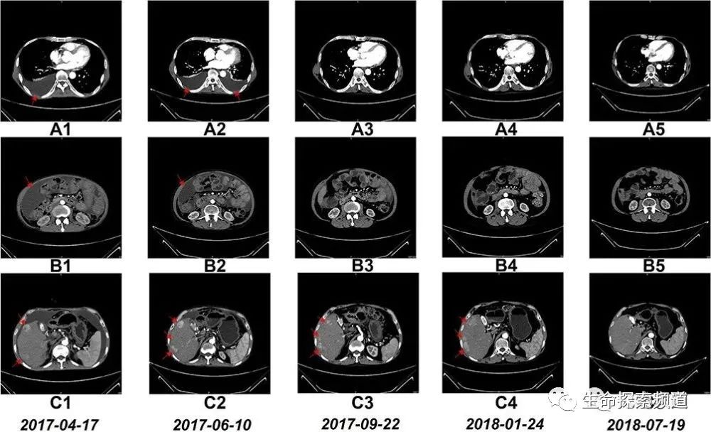 NK细胞疗法让晚期肝癌患者肿瘤显著缩小，从生存期仅3个月到超过4年！(图2)