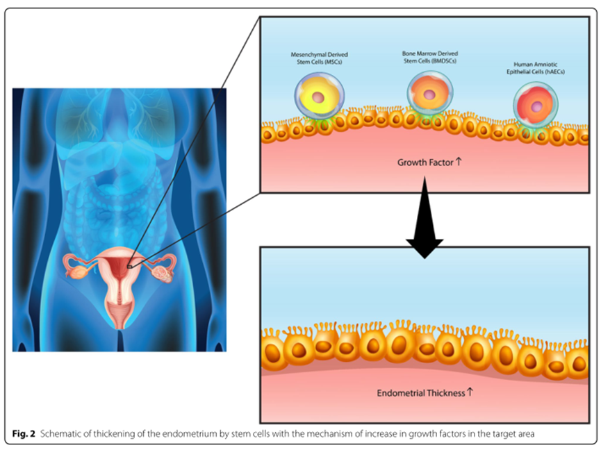 盘点干细胞治疗宫腔粘连临床研究进展| 附最新临床招募信息(图2)