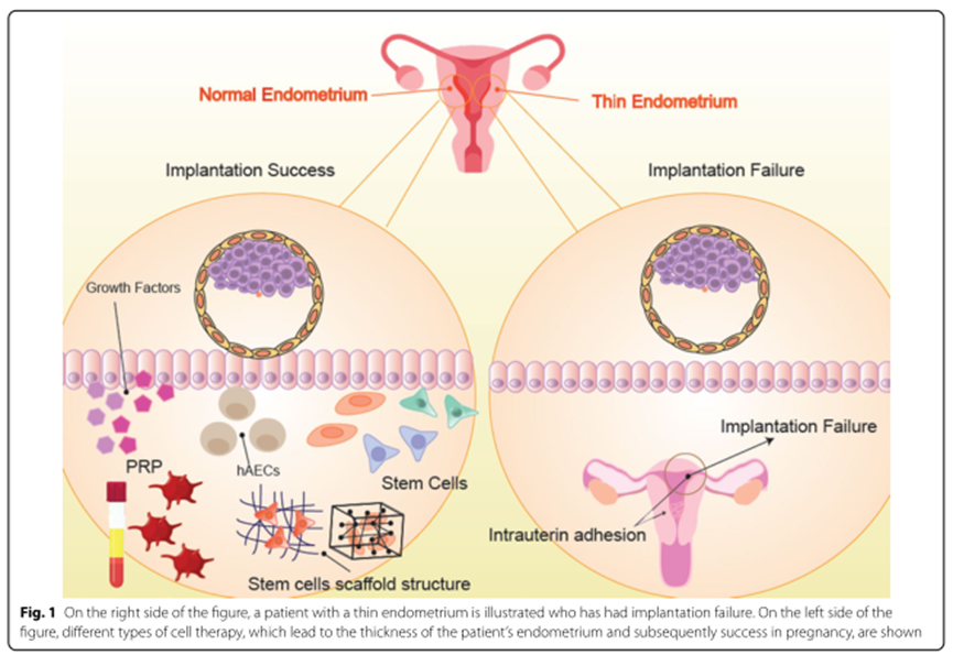 期刊新综述高级别证据：干细胞、PRP等疗法再生子宫内膜，多个家庭成功受孕(图2)