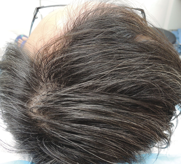 超过30%的“小阳人”可能会脱发！干细胞帮助30岁阳康男性再生新发(图3)