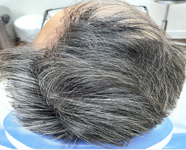 超过30%的“小阳人”可能会脱发！干细胞帮助30岁阳康男性再生新发(图4)