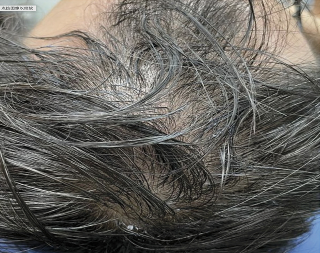 超过30%的“小阳人”可能会脱发！干细胞帮助30岁阳康男性再生新发(图2)